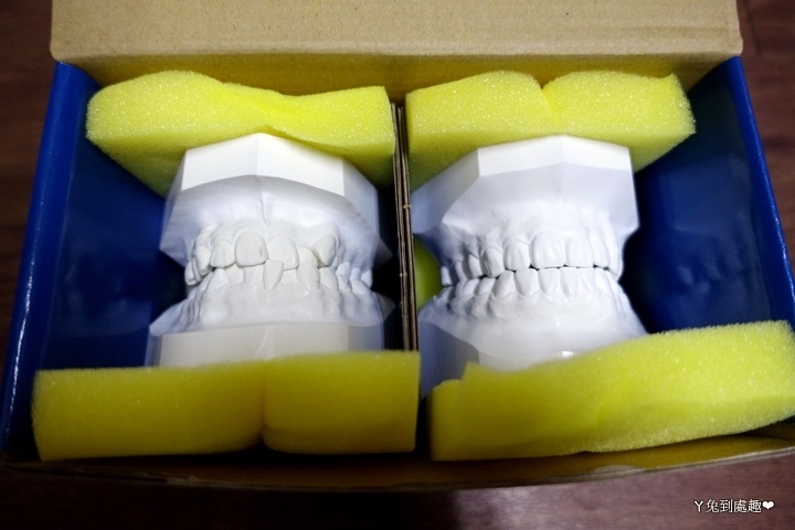 戴维持器,前后差异牙齿模型 (内有牙照请慎入)