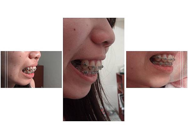 牙套四個月整理