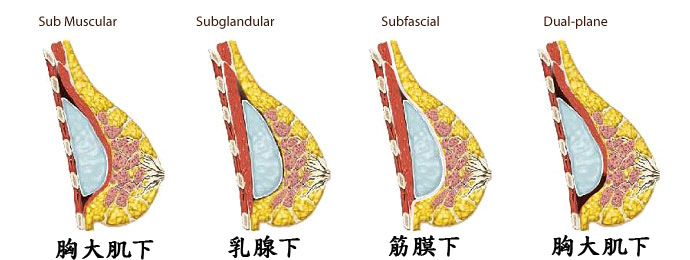2 implant_placement_sites拷貝.jpg