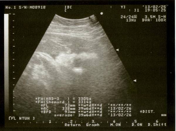 20130225-國泰第12次產檢-側臉(眼眶)