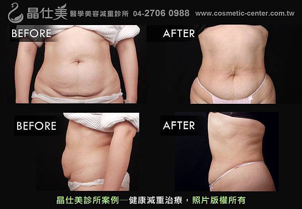 台中減肥診所案例照片照片減重1 台中減肥診所案例照片照片減重1