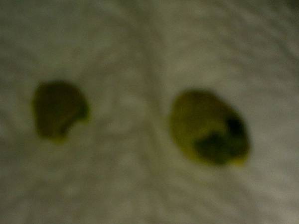 第１１次的肝膽石