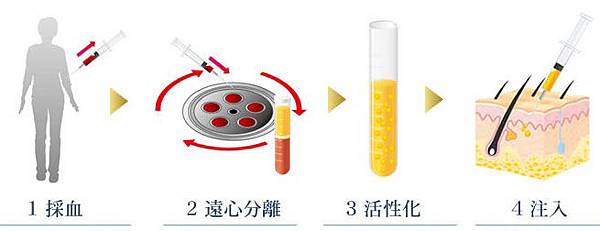 「關節炎 PRP注射」的圖片搜尋結果