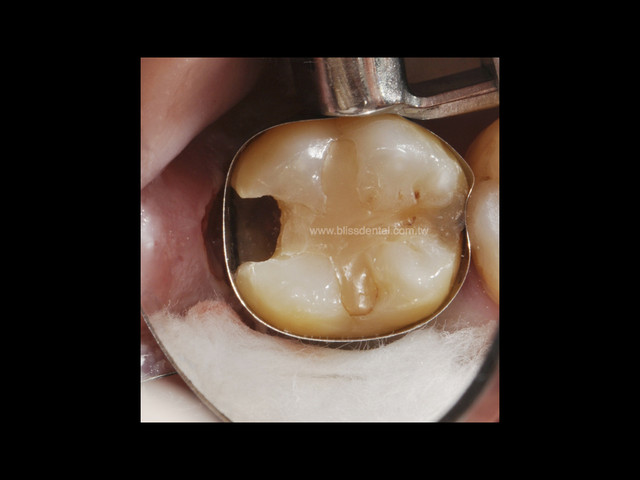 智齿余毒–造成第二大臼齿严重蛀牙