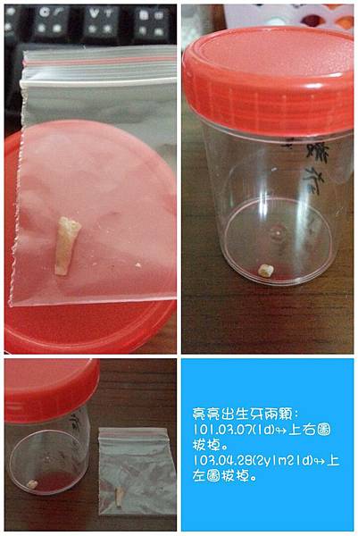 103.04.28亮亮拔掉的出生牙.jpg 103.04.28亮亮拔掉的出生牙.jpg