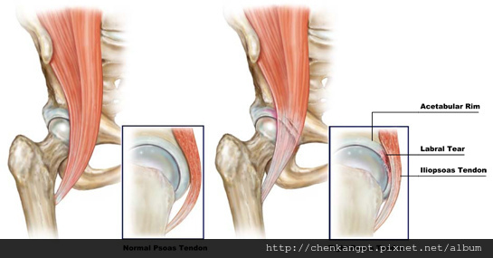 psoas-impingement psoas-impingement