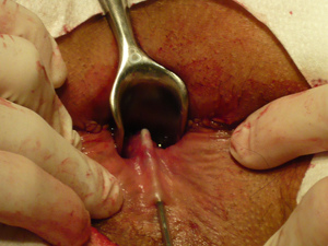 典型廔管 典型廔管