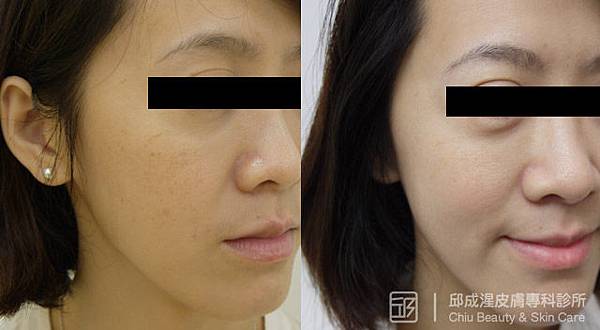 雷射除斑,邱成湦醫師,文山區皮膚科