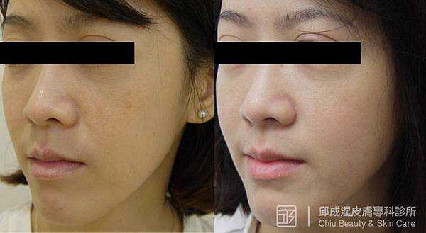 雷射除斑,邱成湦,文山區皮膚科 雷射除斑,邱成湦,文山區皮膚科