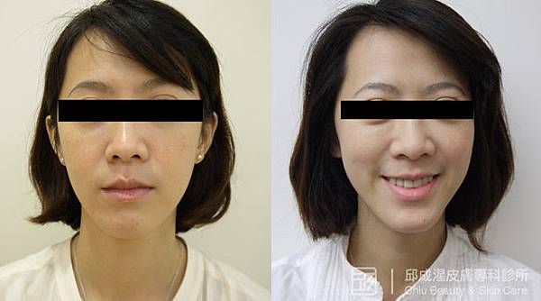 雷射除斑,邱成湦醫師,文山區皮膚科 雷射除斑,邱成湦醫師,文山區皮膚科