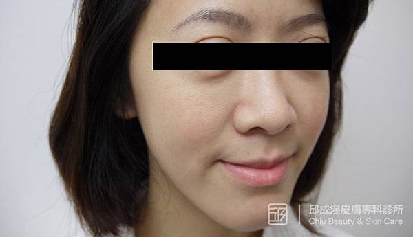 雷射除斑,邱成湦醫師,文山區皮膚科 雷射除斑,邱成湦醫師,文山區皮膚科