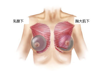 Breast implants above and under the pectoralis muscle