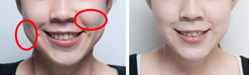 botox156 botox156