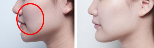 botox151 botox151