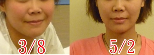 瘦臉成果 (10)