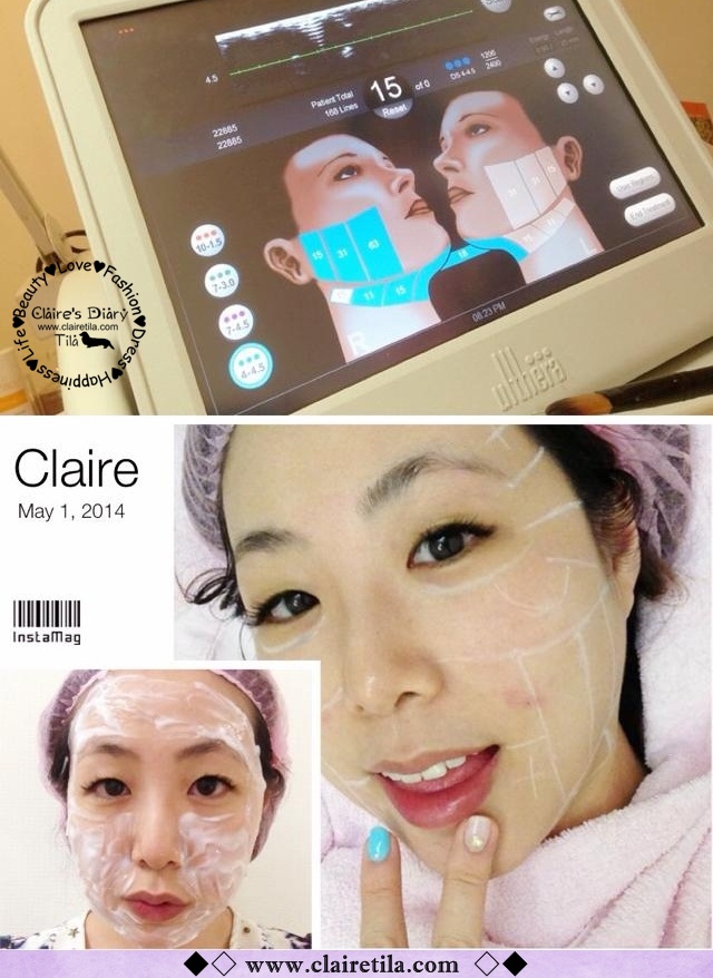 星和台北_Ultherapy極線音波拉提_Claire C妞20