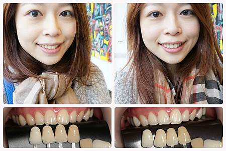 牙齒冷光美白-23-1.jpg