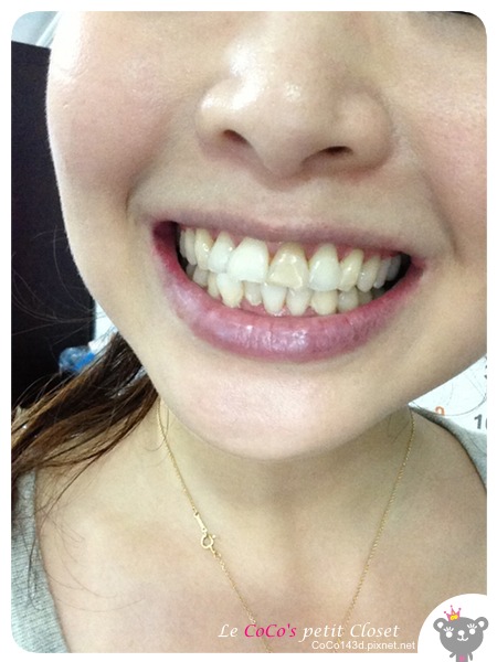 whitening20