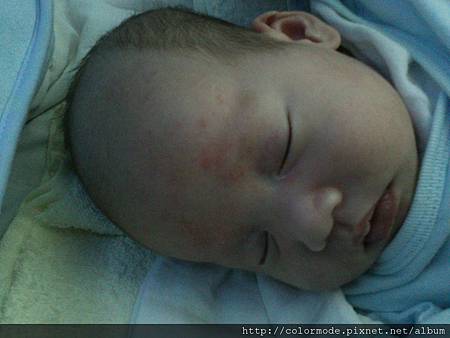 漏脂性皮膚炎 漏脂性皮膚炎