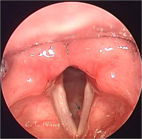 聲帶息肉 治療前 聲帶息肉 治療前