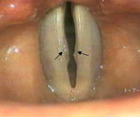 vocal nodule.jpg vocal nodule.jpg