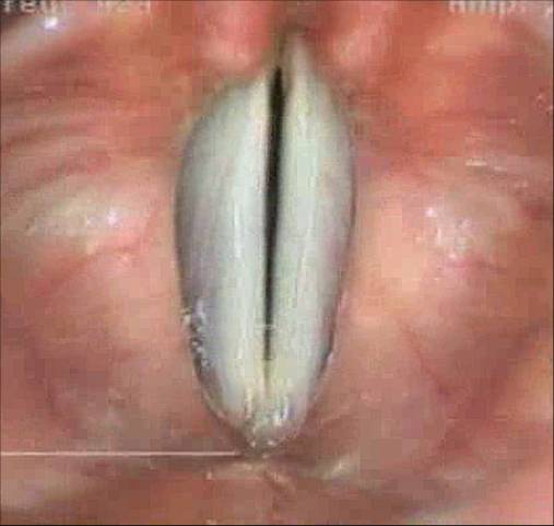 正常聲帶之外觀