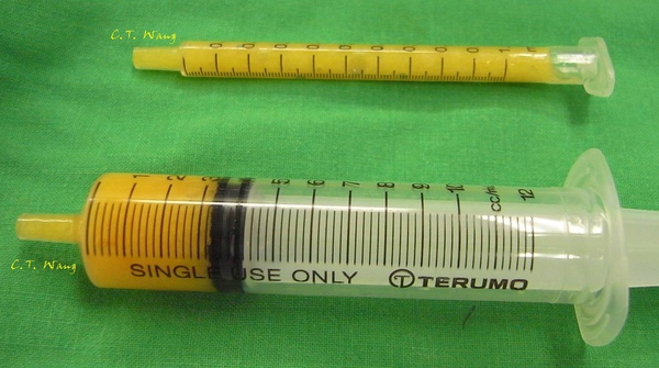 自體脂肪注射2 自體脂肪注射2