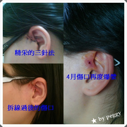 傷口照片.jpg