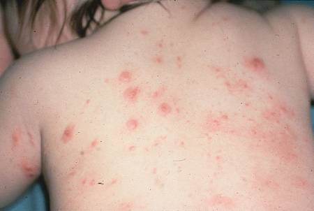 Roseola Prevention - Mayo Clinic