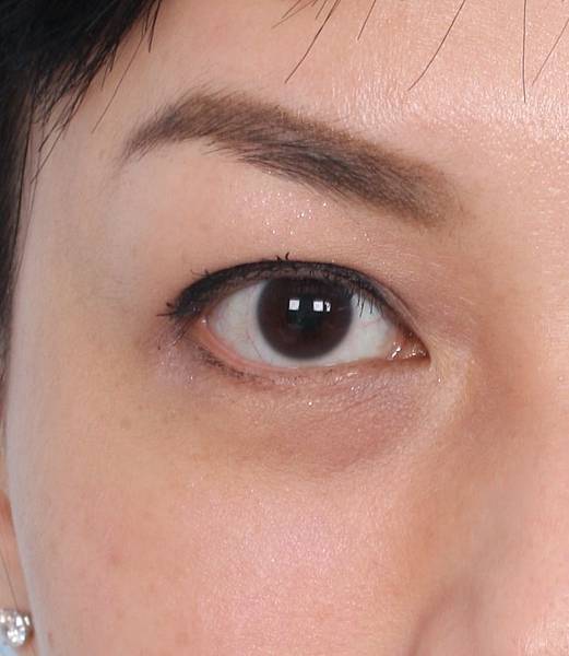 Tear-Trough-Deformity Tear-Trough-Deformity