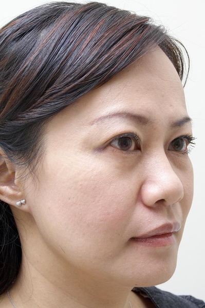 淚溝型黑眼圈會讓睛神空洞而疲憊。.jpg 淚溝型黑眼圈會讓睛神空洞而疲憊。.jpg