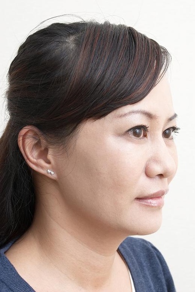 去除淚溝型黑眼圈後,變得烱烱有神。.jpg 去除淚溝型黑眼圈後,變得烱烱有神。.jpg