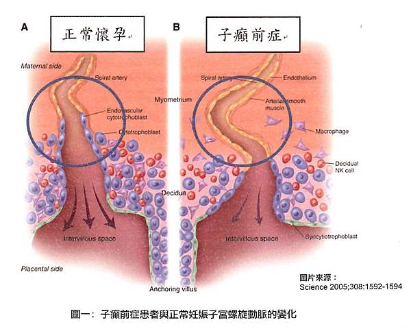 子癲前症患者與正常妊娠子宮螺旋動脈的變化 子癲前症患者與正常妊娠子宮螺旋動脈的變化