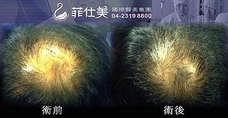 植髮案例-1.jpg