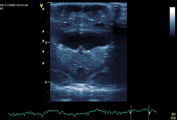 syringomyelia3