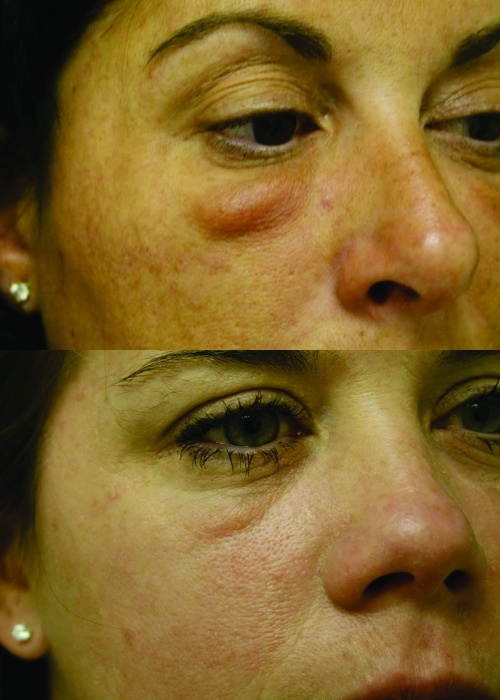 Avoiding Malar Edema During Midface/Cheek Augmentation with Dermal