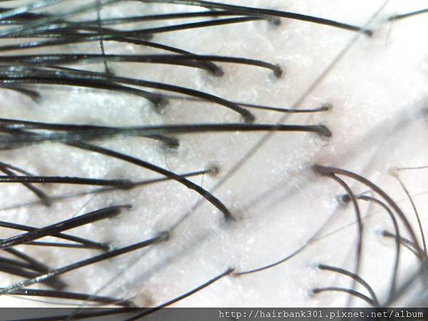 SS.Annunziata银杏洗发精使用&<em>毛囊检测</em>分析