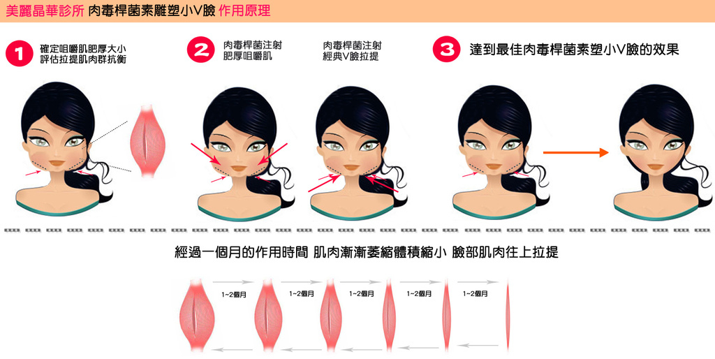 微晶瓷玻尿酸膠原蛋白4D羽毛線拉提維納斯曲線電波3D立體電波拉皮3D立體電波拉皮0005