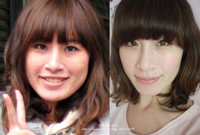 微晶瓷玻尿酸膠原蛋白4D羽毛線拉提維納斯曲線電波3D立體電波拉皮3D立體電波拉皮0007