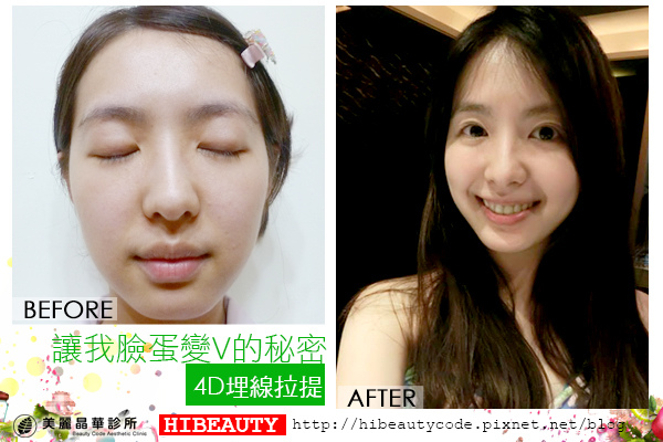 4D羽毛線拉皮 埋線拉皮 價格 推薦 埋線拉皮 推薦 埋線拉皮 費用 美麗晶華 埋線拉提 蘋果肌 嬰兒肥.jpg