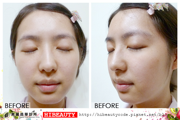 4D羽毛線拉皮 埋線拉皮 價格 推薦 埋線拉皮 推薦 埋線拉皮 費用 美麗晶華 埋線拉提 蘋果肌 嬰兒肥02.jpg 4D羽毛線拉皮 埋線拉皮 價格 推薦 埋線拉皮 推薦 埋線拉皮 費用 美麗晶華 埋線拉提 蘋果肌 嬰兒肥02.jpg