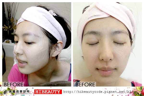 4D羽毛線拉皮 埋線拉皮 價格 推薦 埋線拉皮 推薦 埋線拉皮 費用 美麗晶華 埋線拉提 蘋果肌 嬰兒肥06.jpg