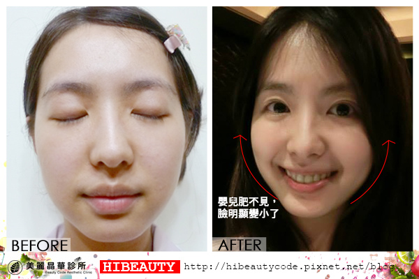 4D羽毛線拉皮 埋線拉皮 價格 推薦 埋線拉皮 推薦 埋線拉皮 費用 美麗晶華 埋線拉提 蘋果肌 嬰兒肥07.jpg 4D羽毛線拉皮 埋線拉皮 價格 推薦 埋線拉皮 推薦 埋線拉皮 費用 美麗晶華 埋線拉提 蘋果肌 嬰兒肥07.jpg