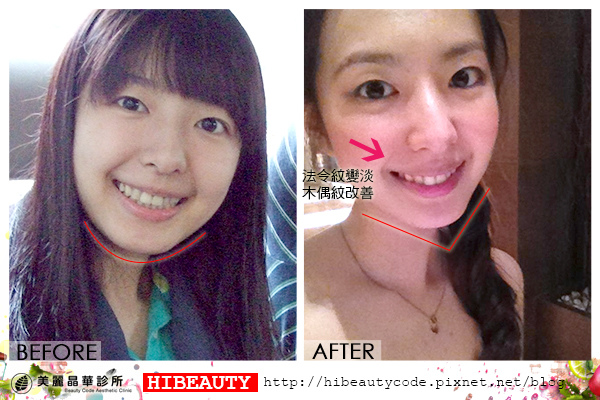 4D羽毛線拉皮 埋線拉皮 價格 推薦 埋線拉皮 推薦 埋線拉皮 費用 美麗晶華 埋線拉提 蘋果肌 嬰兒肥09.jpg 4D羽毛線拉皮 埋線拉皮 價格 推薦 埋線拉皮 推薦 埋線拉皮 費用 美麗晶華 埋線拉提 蘋果肌 嬰兒肥09.jpg