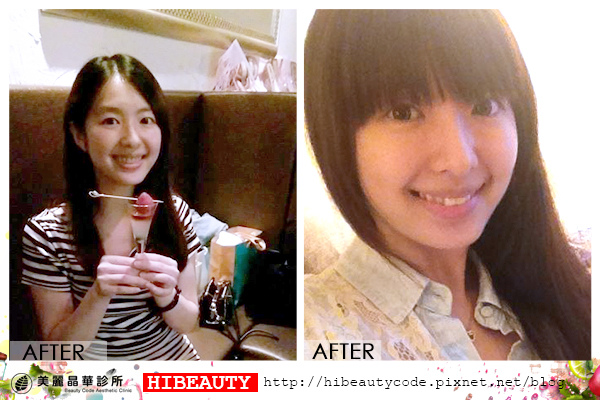 4D羽毛線拉皮 埋線拉皮 價格 推薦 埋線拉皮 推薦 埋線拉皮 費用 美麗晶華 埋線拉提 蘋果肌 嬰兒肥10'.jpg