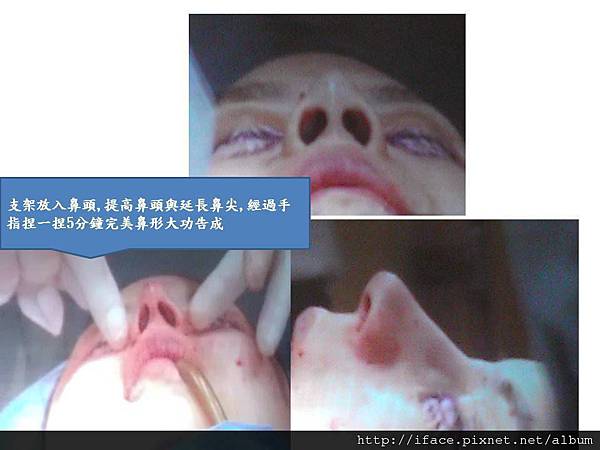 4 D支架隆鼻線雕 12999: 美鼻整形術,鼻埋線,鼻雕,