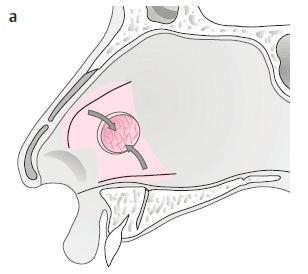 septal perforation08.jpg