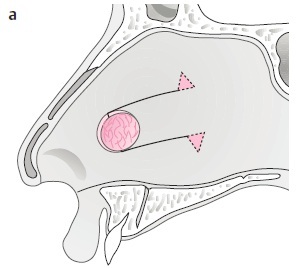 septal perforation07.jpg