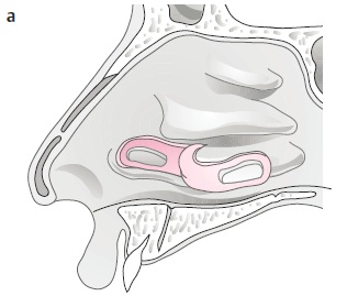 septal perforation09.jpg
