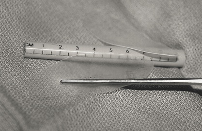 septal perforation06.jpg